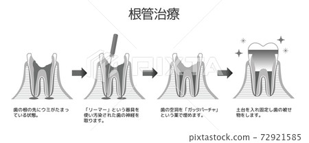 Black and White Printed Caries and Progression and Treatment: Dental Illustrations 72921585