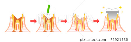 Caries and Progression and Treatment: Dental Illustration 72921586