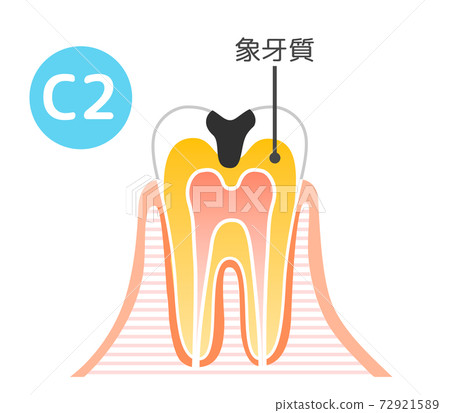 牙科插圖：牙科插圖 72921589