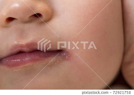 孩子嘴巴周圍的皮膚粗糙 72921758