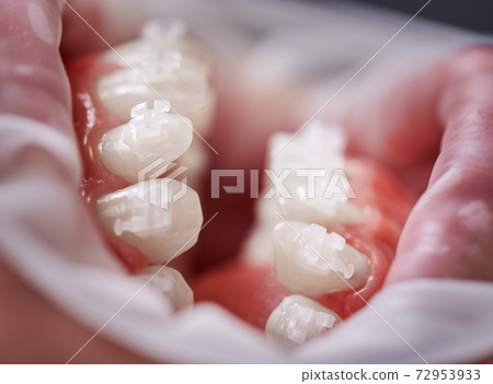 White orthodontic brackets on patient teeth. 72953933