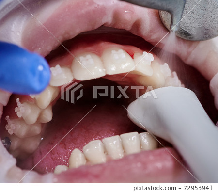 Doctor doing professional teeth cleaning in dental clinic 72953941