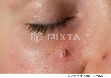 Acne on a woman's face close up. Portrait of a woman with problem skin 72968992