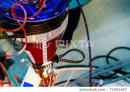 Apparatus circulation blood heart lung machine for heart surgery in operating room 72992487