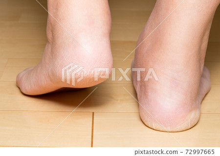 支撐體重的腳踝疼痛,腳後跟疼痛圖像 支撐體重的腳踝疼痛,腳後跟疼痛圖像 72997665