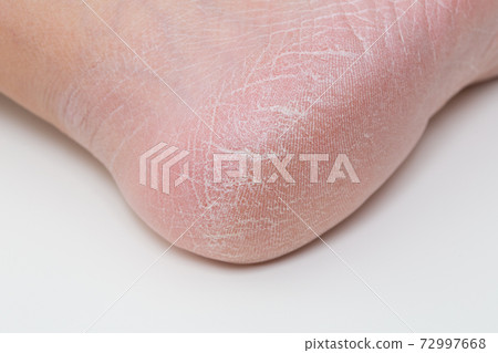 角質鞋跟粗糙粗糙 72997668