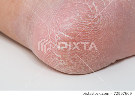 角質鞋跟粗糙粗糙 角質鞋跟粗糙粗糙 72997669