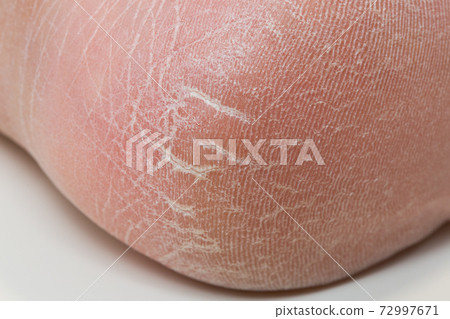 Horny heel cracks rough 72997671