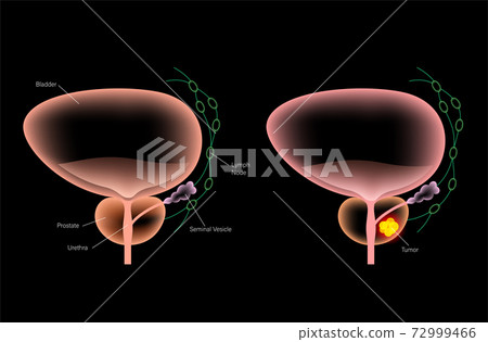 Prostate cancer concept 72999466