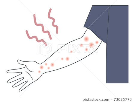Illustration of an arm with atopy, urticaria, shingles, and eczema 73025773
