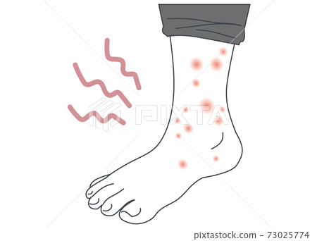 Illustration of foot with atopy, urticaria, shingles, eczema 73025774
