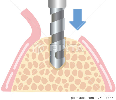 Implant treatment surgery illustration 73027777