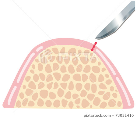 Implant treatment incision surgery illustration 73031410
