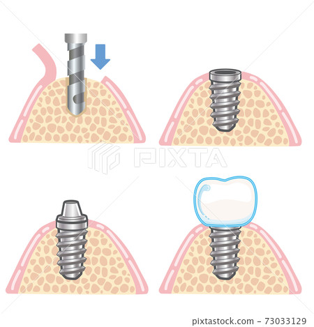Implant one-time method illustration 73033129