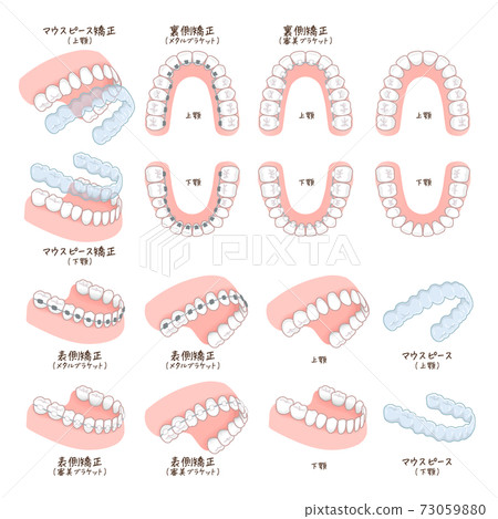 正畸設備的插圖 73059880