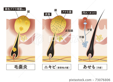 鬍鬚 鬍子 髭 73076806