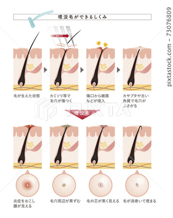 loss of hair, vector, vectors 73076809