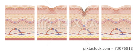 skin, skinned, cross-section diagram 73076818
