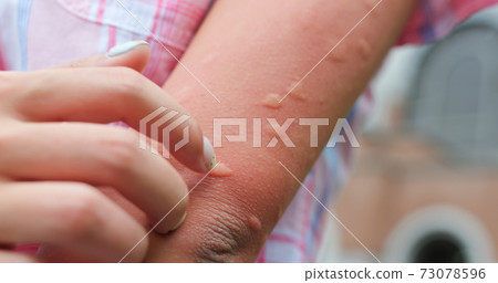 Bitten by mosquito in summer Bitten by mosquito in summer 73078596