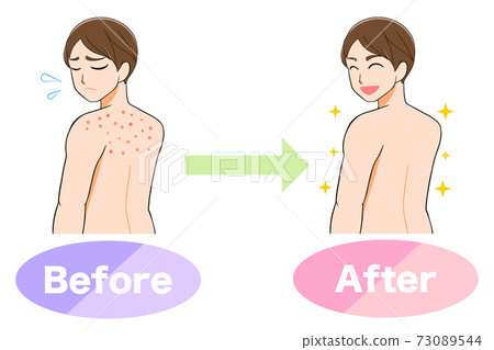 Illustration of a before-after man suffering from acne on his back 73089544