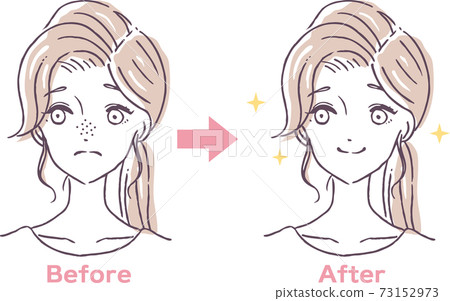 Before and after illustration material of a woman suffering from pore clogging 73152973