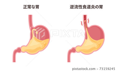 胃和胃酸反流性食管炎的插圖 插圖素材 圖庫