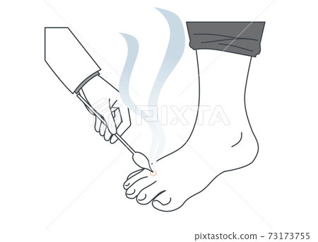 用液氮治療腳部腫脹的插圖 用液氮治療腳部腫脹的插圖 73173755