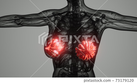 medical scan of Woman Breast Cancer 73179120