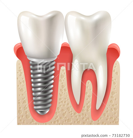 Dental Implant Tooth Set Closeup Model 73182730