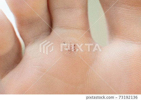 wart on a blunt close-up. Macro shot of human papilloma on the foot. wart on a blunt close-up. Macro shot of human papilloma on the foot. 73192136
