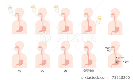 Illustrations of tube feeding types and illustrations_Stomach wax_NG_OG_OE Illustrations of tube feeding types and illustrations_Stomach wax_NG_OG_OE 73218200