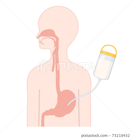 Gastric fistula_PEG tube illustration_body cross section 73218432