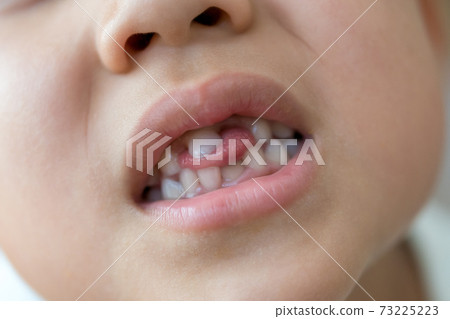 Regeneration of milk teeth 73225223