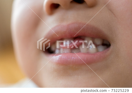 Regeneration of milk teeth Regeneration of milk teeth 73225229