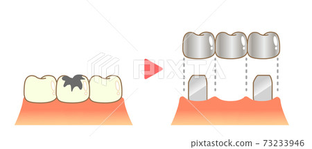 Bridge Caries and Progression and Treatment: Dental Illustration 73233946