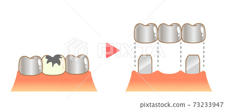 Bridge treatment Caries and progression and treatment 73233947
