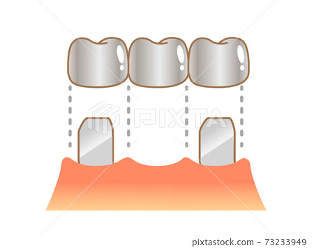 Bridge Caries and Progression and Treatment: Dental Illustration 73233949