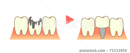 Implant Treatment Caries and Progression and Treatment 73233950