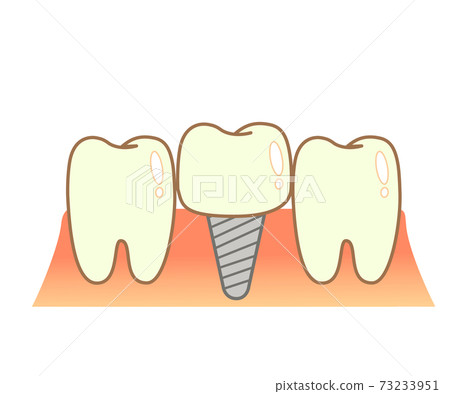 Implant Caries and Progression and Treatment: Dental Illustration 73233951