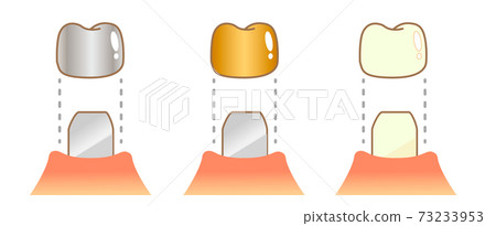 Crown Caries and Progression and Treatment: Dental Illustration 73233953