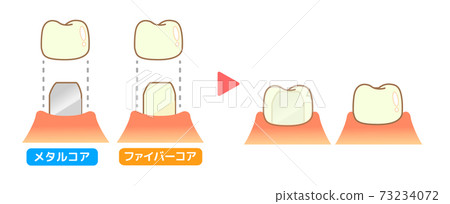 Crown Caries and Progression and Treatment: Dental Illustration 73234072