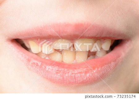 Close-up of a small boy with curved teeth smiling 73235174