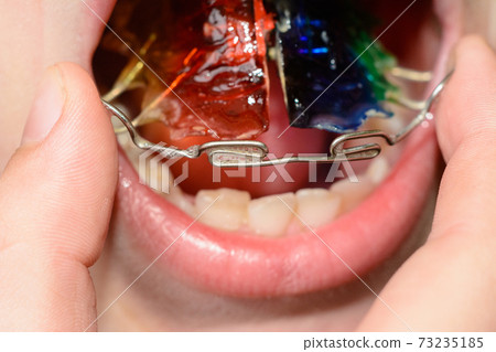 A big plan for dressing a metal plate for tooth bristling A big plan for dressing a metal plate for tooth bristling 73235185