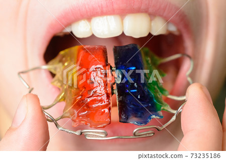 Close-up mouth of crooked teeth with braces Toothbrush in the mouth of the adolescent Close-up mouth of crooked teeth with braces Toothbrush in the mouth of the adolescent 73235186
