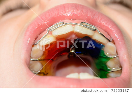 Close-up of a metal plate in the mouth on the teeth of a little boy Close-up of a metal plate in the mouth on the teeth of a little boy 73235187