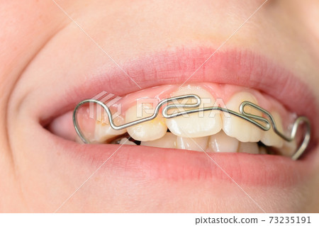Close-up of a metal plate in the mouth on the teeth of a little boy Close-up of a metal plate in the mouth on the teeth of a little boy 73235191