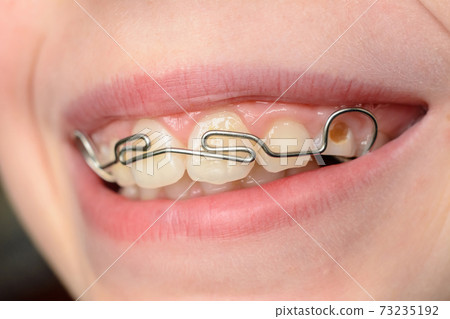 Close-up mouth of crooked teeth with braces Toothbrush in the mouth of the adolescent Close-up mouth of crooked teeth with braces Toothbrush in the mouth of the adolescent 73235192