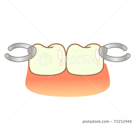 Illustration of partial dentures: illustration of dentistry 73252948