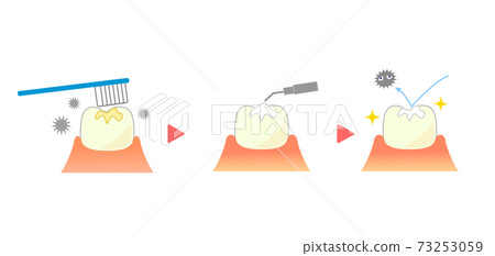 Description of sealant treatment Cross section of teeth Description of sealant treatment Cross section of teeth 73253059