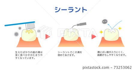 Description of sealant treatment Cross section of teeth Description of sealant treatment Cross section of teeth 73253062